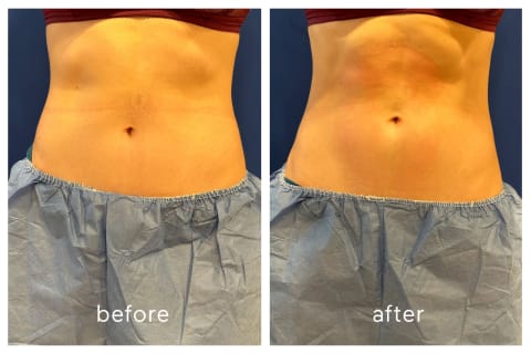 Jamie's before and after results from emsculpt