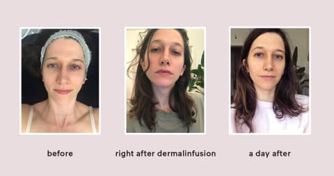 Dermalinfusion Facial Review Here s What It s Really Like - 34