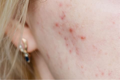 woman with acne on sheeks