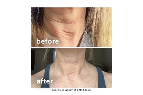 before and after of Lyma Laser usage on the neck