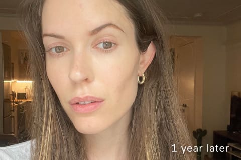 mindbodygreen beauty director Alexandra Engler after using the Lyma Laser for 1 Year