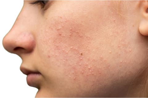 woman with small bumps on her face