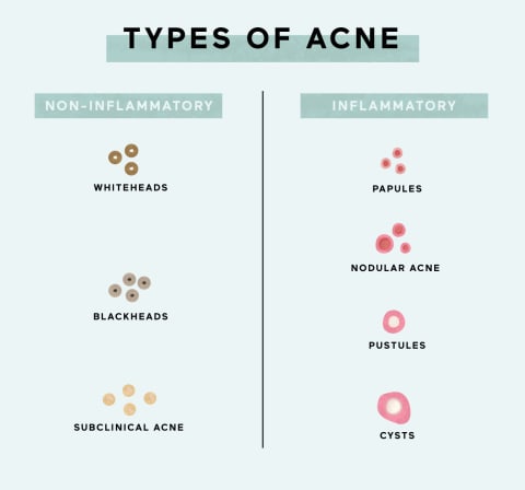 7 Common Types Of Acne   How To Treat Each Of Them - 85