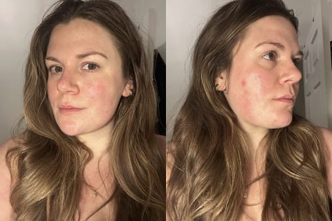 Side by side of skin before using red light therapy
