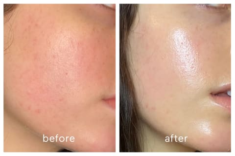 hydrafacial before and after