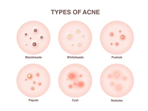 types of pimples
