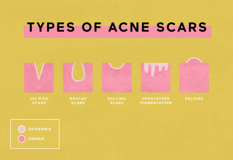 types of acne scars graphic 