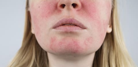 Rash on Face: Causes, Treatments, Prevention, and More