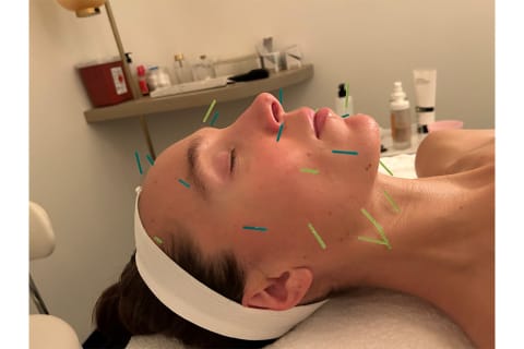 Know before you book: acupuncture facial during the treatment