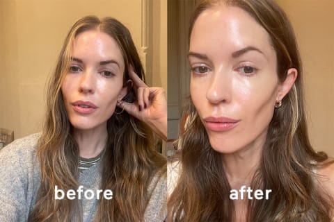 mindbodygreen beauty director Alexandra Engler before and after using the LYMA laser