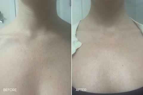 Bon Charge Red Light Neck & Chest Mask Review: Before & After Bon Charge Red Light Neck & Chest Mask Review: Before & After