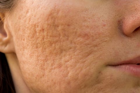 woman with acne scars