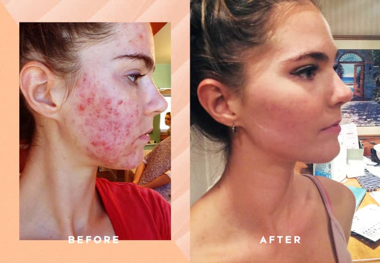 What I Ate To Get Rid Of My Cystic Acne