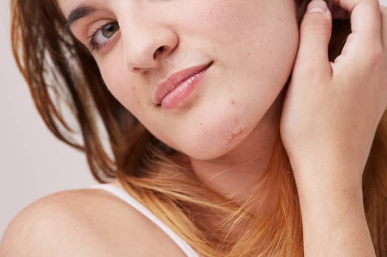 woman with slight acne on her chin 