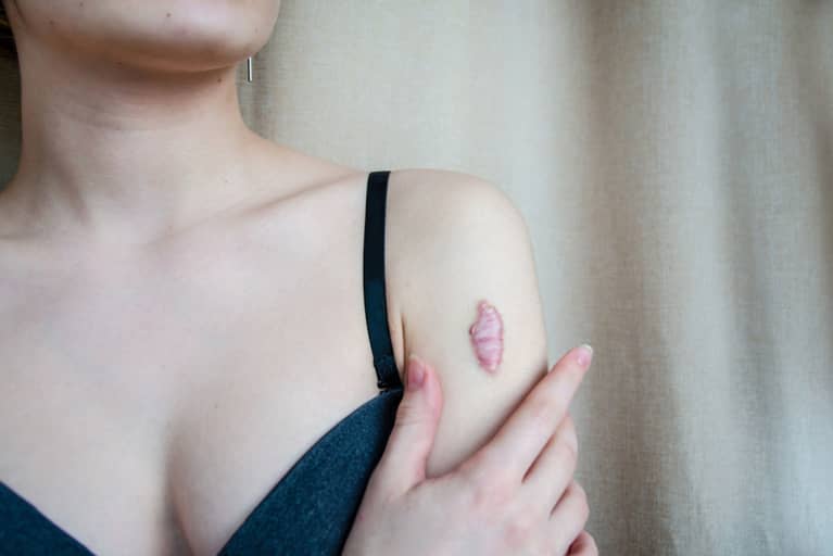 Here's Exactly How To Prevent & Treat Keloid Scars, From Dermatologists