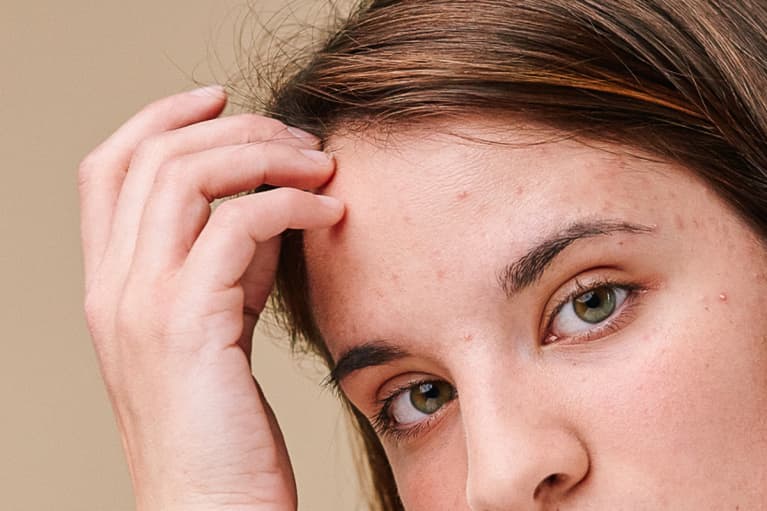 Young Woman With Acne Touching Her Forehead
