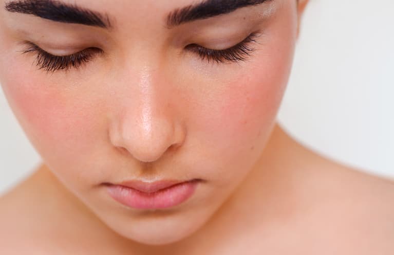 3 Surprising Rosacea Triggers You Probably Never Suspected From A Derm