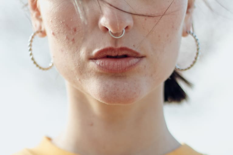 Woman With Acne