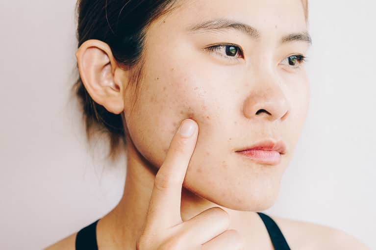 Woman with Acne Scars