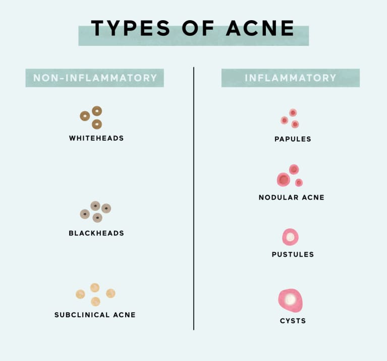 Types of acne 