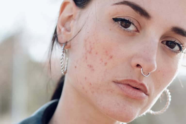 This Combination Of Factors REALLY Causes Acne, According To A New Study
